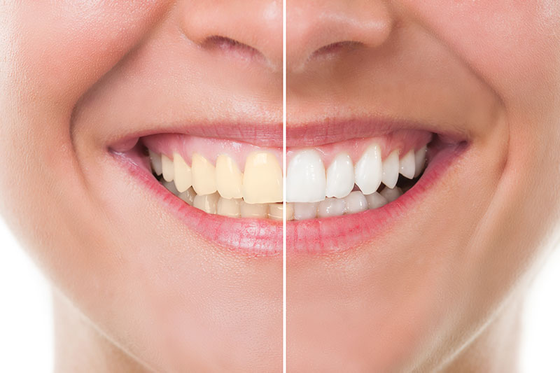 Teeth Whitening in West Jordan